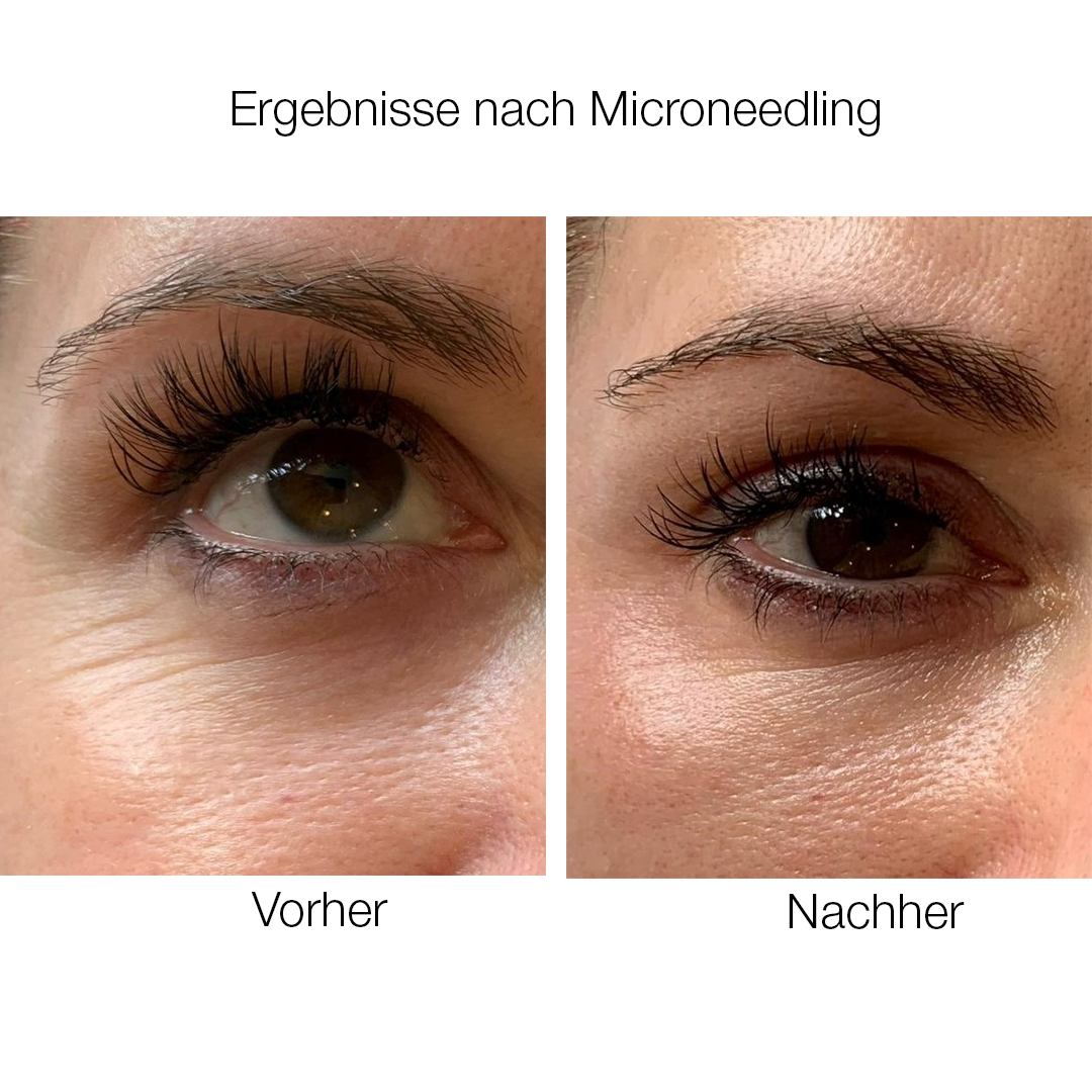 Medizinisches Microneedling -Kosmetikstudio JOU care for beauty